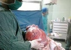 خارج کردن توده 6 کیلویی از شکم بیماری در کنگان +عکس خارج کردن توده 6 کیلویی از شکم بیماری در کنگان +عکس
