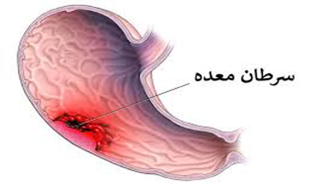 چند راهکار برای درمان سرطان معده چند راهکار برای درمان سرطان معده