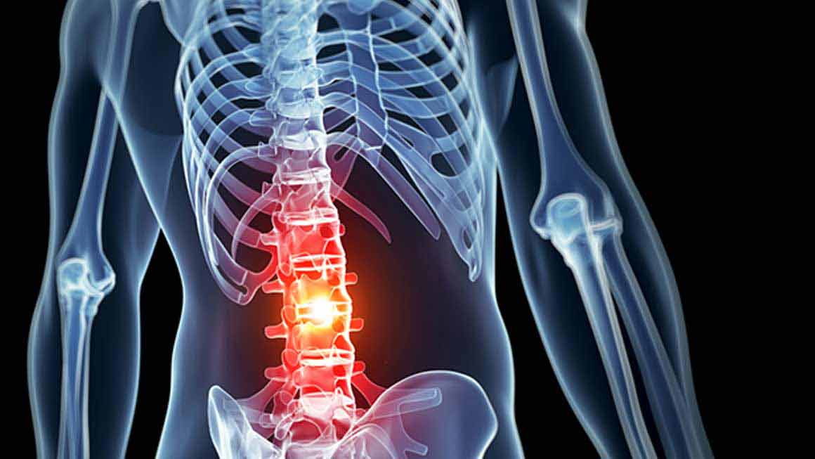 کدام افراد دچار بیرون زدگی دیسک کمر می‌شوند؟