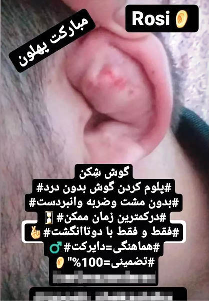 شکستن و پلمب کردن گوش تضمینی بدون درد و خونریزی! شکستن و پلمب کردن گوش تضمینی بدون درد و خونریزی!
