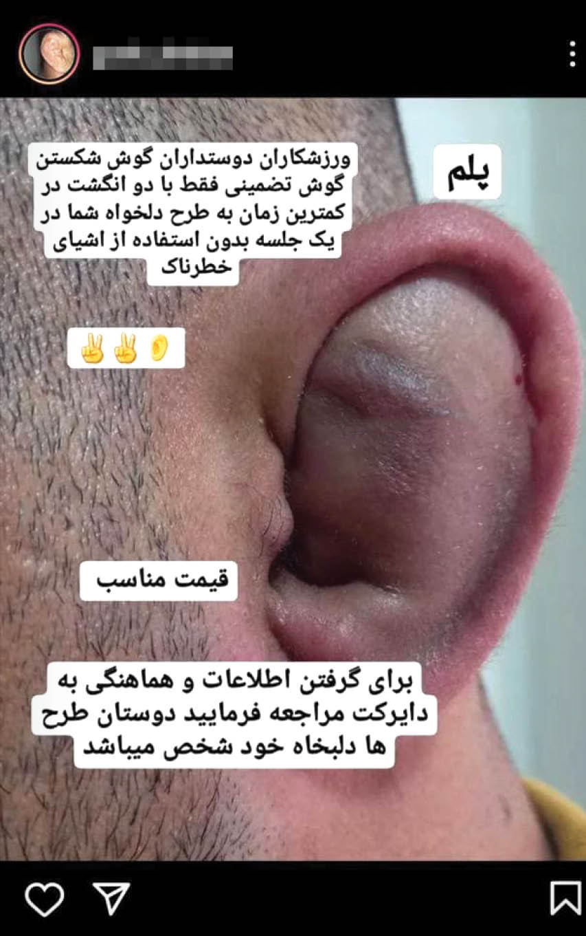 شکستن و پلمب کردن گوش تضمینی بدون درد و خونریزی! شکستن و پلمب کردن گوش تضمینی بدون درد و خونریزی!