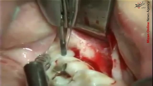 چرا باید دندان عقل را جراحی کنیم؟(گزارش55) چرا باید دندان عقل را جراحی کنیم؟(گزارش55)