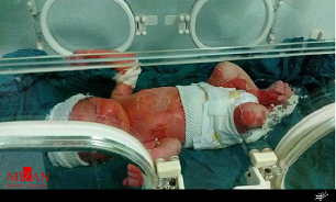 تشکیل پرونده برای عامل سوختگی نوزاد سه روزه/ پرونده در دادسرای صومعه سرا در حال رسیدگی است
