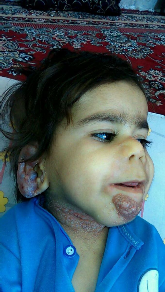 مبتلا به یک بیماری ژنتیکی نادر +تصاویر مبتلا به یک بیماری ژنتیکی نادر +تصاویر