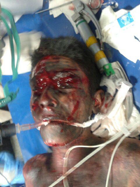 انفجار مواد محترقه دو دست نوجوان کرمانشاهی را قطع کرد(عکس 16+)