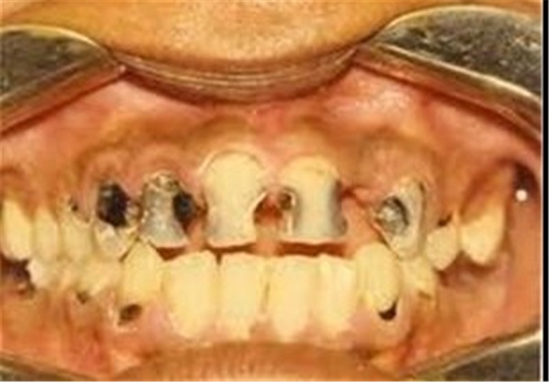 یک قرن تلاش برای دستیابی به دندان‌های روشن‌ +عکس