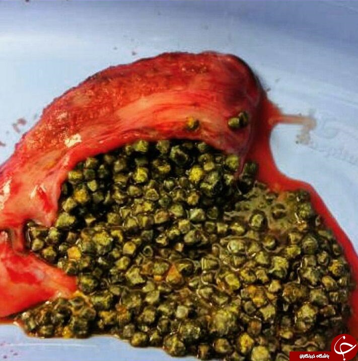 سنگ هایی به اندازه عدس تا توپ گلف داخل بدن + عکس