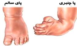 پاجنبری شایع‌ترین مشکل ارتوپدی در کودکان