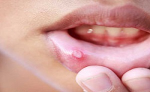 تاثیر خارق العاده قهوه بر روی بدن/درمان خانگی آفت دهان بدون دارو تاثیر خارق العاده قهوه بر روی بدن/درمان خانگی آفت دهان بدون دارو