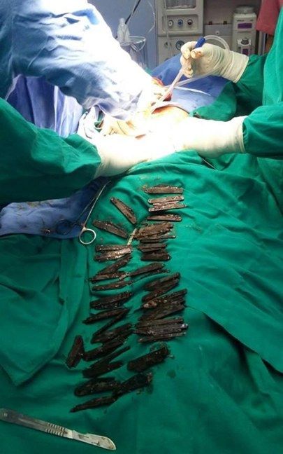 خارج کردن ۴۰ چاقوی فلزی از معده بیمار هندی+عکس خارج کردن ۴۰ چاقوی فلزی از معده بیمار هندی+عکس