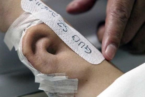 آماده سازی گوش مصنوعی بر بازوی بیمار
