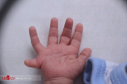 تولد نوزاد ۲۴ انگشتی در گناباد + تصاویر