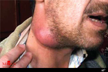 الکلی ها بیشتر دچار سرطان های سر و گردن می شود/ درمان 90 درصدی سرطان با تشخیص زودهنگام