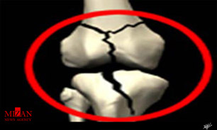 هشدار در مورد ابتلا به پوکی استخوان
