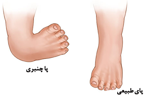 ابتلا کودکان به پا چنبری مادر زادی