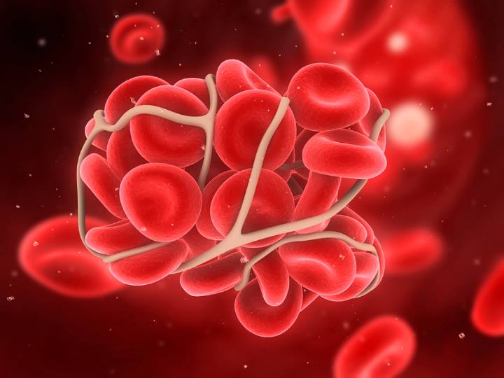 ثبت ۱۱۲۵۰ بیمار هموفیلی و سایر اختلالات خونریزی دهنده در وزارت بهداشت