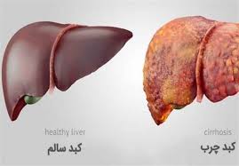بی تحرکی و تغذیه ناسالم علت بیماری‌های گوارشی/۴۰ درصد مردم ایران کبد چرب دارند