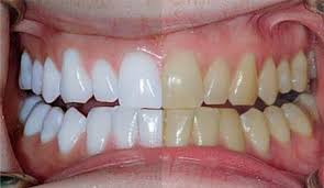 مزایا و معایب بلیچینگ دندان چیست؟