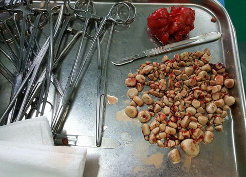 خارج کردن 276 عدد سنگ از مثانه یک بیمار در بیمارستان دکتر شریعتی مشهد