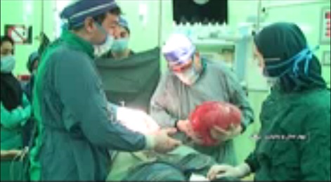 خارج کردن توده 11 کیلویی از شکم دختر 18 ساله خارج کردن توده 11 کیلویی از شکم دختر 18 ساله
